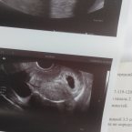 Тут 6-7 недель, уже было сердцебиение 💓