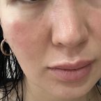 Я была у дерматолога,она мне прописала мази но от них даже хуже,