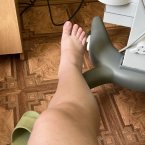 Вот такой был отек также ближе у родам отекло лицо